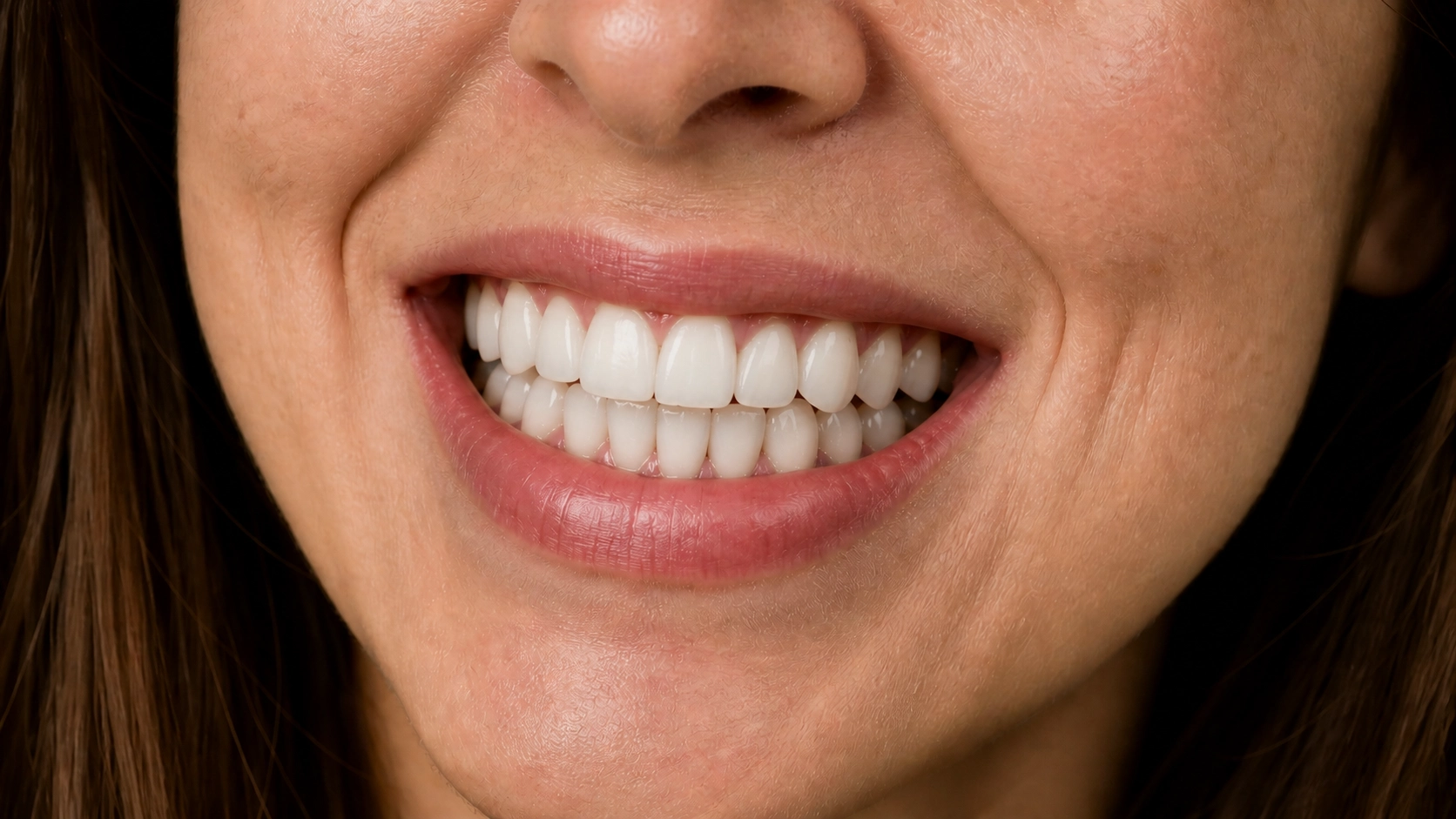 After smile transformation 1