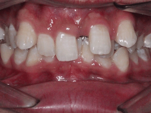 Before clear aligner treatment for complex bite issues
