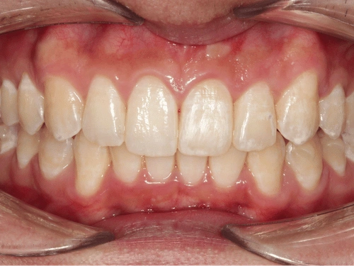 After clear aligner treatment for complex bite issues