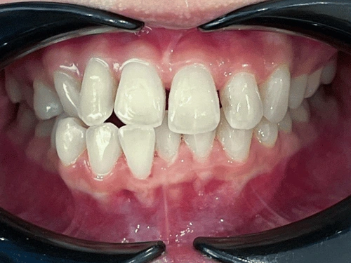 Before clear aligner treatment for cross bite case