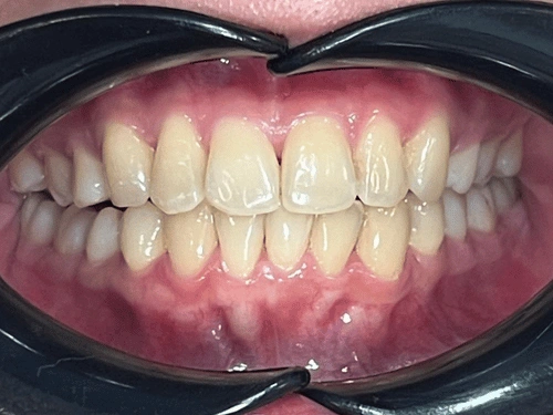 After clear aligner treatment for cross bite case