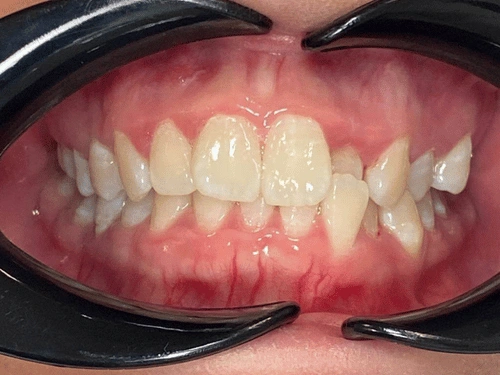Before clear aligner treatment for crowding case