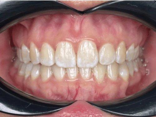 After clear aligner treatment for crowding case