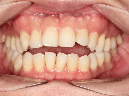 Before clear aligner treatment for open bite case
