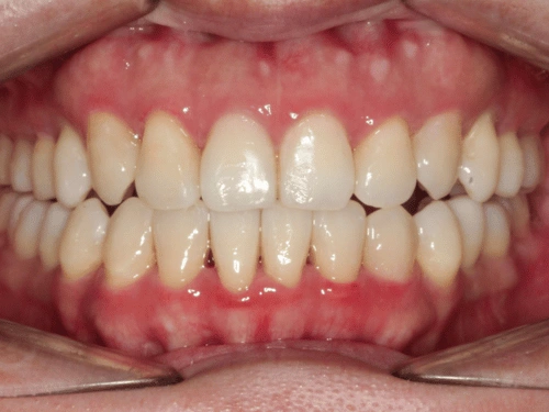 After clear aligner treatment for open bite case