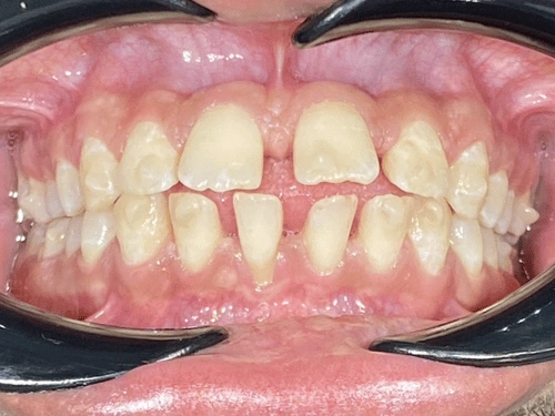 Before clear aligner treatment for spacing case