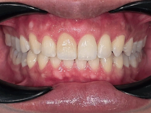 After clear aligner treatment for spacing case