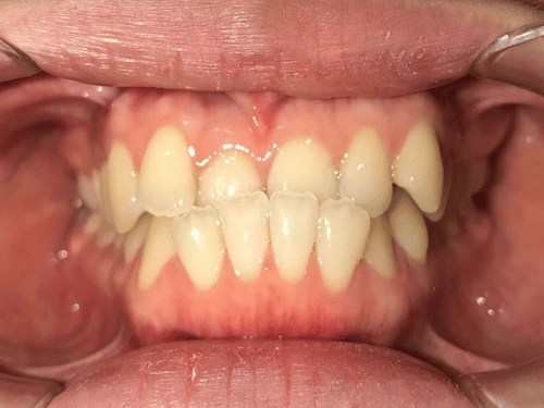 Before clear aligner treatment for under bite case