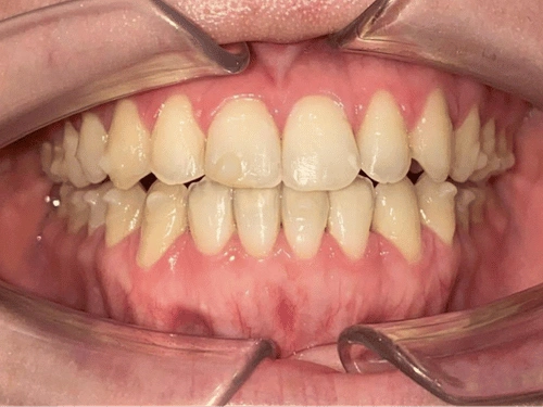 After clear aligner treatment for under bite case