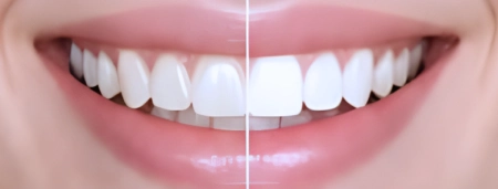 SEBARIS BRIGHTENING smile result
